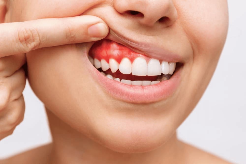 cirugia_para_sonrisa_gingival_en_ciudad_de_mexico.jpg